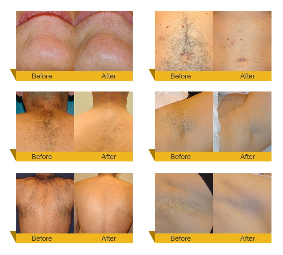 Hottest Germany Device 808 Diode/hair Removal Diode Laser Machine